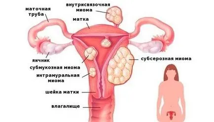 Ce hormoni trebuie să bea cu fibrom uterin si de ce