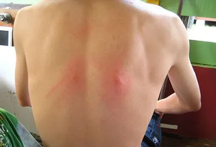 Cum sa scapi de intepaturi de tantar 7 moduri eficiente (pentru a scapa de o muscatura de tantar) Cum să scapi de înțepături de țânțar 7 modalități eficiente