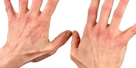 După cum începe psoriazisul - primele semne ale apariției de placi, simptome si cauze (semne) Ca psoriazis incepe - primele semne ale apariției de placi, simptome si cauze
