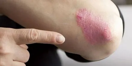 După cum începe psoriazisul - primele semne ale apariției de placi, simptome si cauze (psoriazis) Ca psoriazis incepe - primele semne ale apariției de placi, simptome si cauze