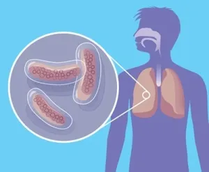 Cum de a identifica tuberculoza la domiciliu primele semne și simptome (astfel cum sunt definite de tuberculoza la domiciliu primele semne de simptome în stadiu incipient pare să înțeleagă) Cum de a identifica tuberculoza la domiciliu primele semne și simptome