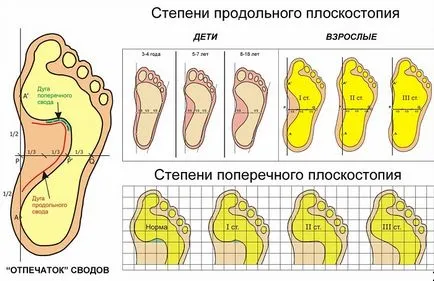 Cum de a stabili plat la domiciliu (primul metatarsian) Cum de a stabili plat la domiciliu