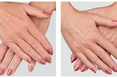 Pielea uscata de mâini - ce să facă, crăpate și sângerare, ce să facă la crema de acasă