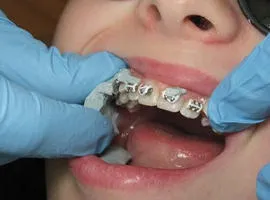 Cum de a elimina acolade sunt reale fotografii și clipuri video doctor, dacă procedura de retragere dureroasă
