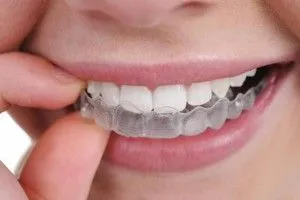 Cum de a elimina bretele, și cât de mult este posibil la domiciliu (acolade) Cum de a elimina bretele, și cât de mult este posibil la domiciliu