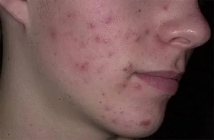 Cum de a elimina acnee, care ajută să scapi de acnee