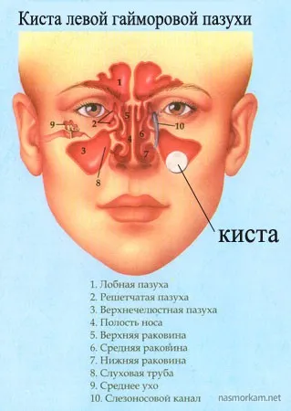 Un chist in nas (sinusurilor nazale) simptome, tratament, consecinte (sinus) Un chist in nas (sinusuri nazale) simptome, tratament, consecințe