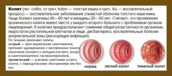 Colite, simptome intestinale si tratamentul de remedii populare - cele mai bune și cele mai eficiente rețete