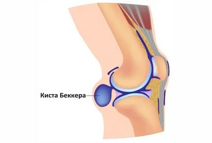 Chist Becker sub genunchi - cum să trateze cauza, prevenirea (Becker) chist Bekker spatele genunchiului - cum să trateze cauzele, prevenirea