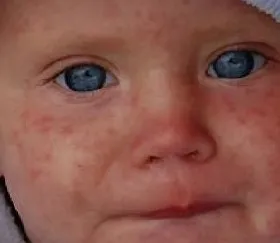 Rubeola în fotografii pentru copii, simptome și tratament, prevenirea (rubeolă la copii) Rubeola în fotografii pentru copii, simptome și tratament, prevenire