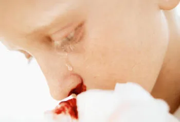 Nosebleed ce boli pot provoca epistaxis