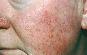 Tratamentul de acnee rozacee pe fata la pozele de acasă, comentarii, medicamente pentru îmbunătățirea performanțelor (la domiciliu cosmetice y) Tratamentul de acnee rozacee pe fata la pozele de acasă, comentarii, medicamente pentru îmbunătățirea performanței