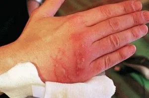 Tratamentul arsurilor de apă caldă în casă (acasă, puteți) Tratamentul arsurilor de apă caldă în casă