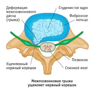 Tratament Herniile intervertebrale fără operație, metode eficiente