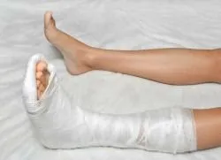 Este posibil să calce pe piciorul în ghips