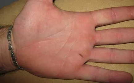 În palma o alunita părea că aceasta ar putea însemna