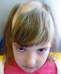 Norma pierderea parului pe zi - atunci când spălarea, pieptănare (ziua) Norma pierderea parului pe zi - atunci când spălarea, pieptănare