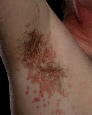 Primele semne ale psoriazisului