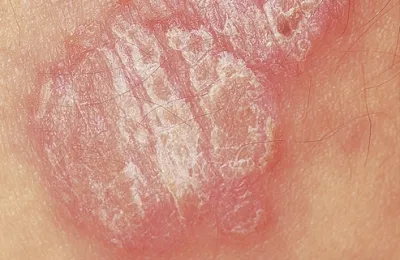 Primele semne ale psoriazisului