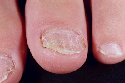 Primele semne ale psoriazisului