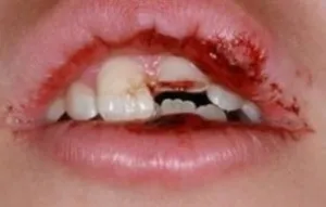 De ce pradă, pauza, dintii rupte care fac, restaurarea dintelui distrus
