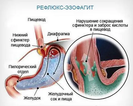 De ce gâdilă în mod constant în gât provoacă durere acest lucru (de ce) De ce gâdilă în mod constant în gât din motivele pentru o astfel de gâdilat