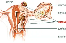 intervenții chirurgicale abdominale