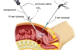 intervenții chirurgicale abdominale