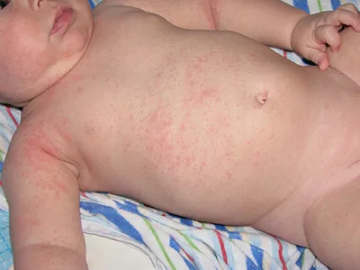 Sudamen la copii cauze, simptome, tratament si prevenire in casa