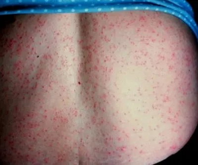 Sudamen la copii cauze, simptome, tratament si prevenire in casa