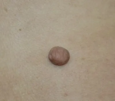 Cauzele mici umflături pe cap, fotografii