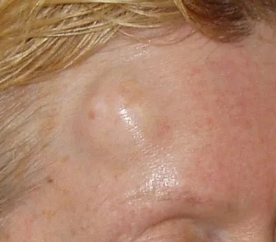 Cauzele mici umflături pe cap, fotografii