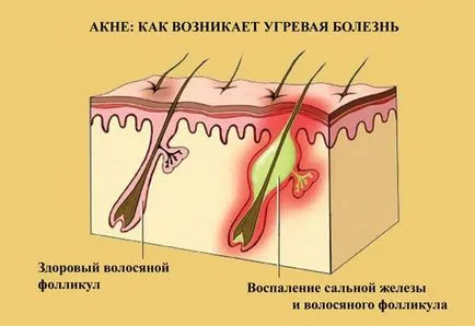 Acnee pe spate la barbati si femei - cauze si tratament