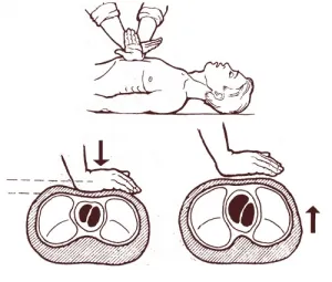 persoana de resuscitare