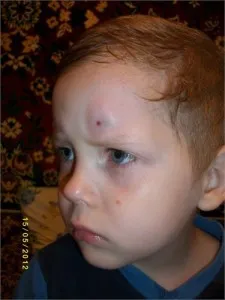 Un cucui pe cap doare cauze atunci când sunt apăsate, diagnostic, tratament (cap) Un cucui pe cap doare cauze atunci când sunt apăsate, diagnostic, tratament