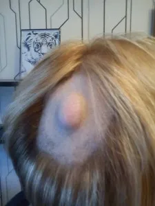 Un cucui pe cap doare cauze atunci când sunt apăsate, diagnostic, tratament (motive) Un cucui pe cap doare cauze atunci când sunt apăsate, diagnostic, tratament
