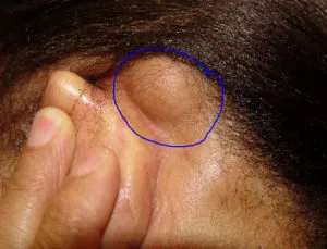Cone în spatele urechii ca un semn de cancer (ureche) Bump în spatele urechii ca un semn de cancer