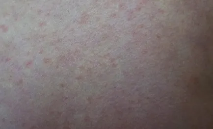 descuamarea pielii între fotografie picioare, este posibil boala, tratament, excrescente pe piele
