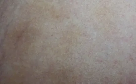 descuamarea pielii între fotografie picioare, este posibil boala, tratament, excrescente pe piele
