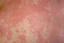 Rash pe coapse cauze, tratament (erupție pe coapse) Erupții cutanate pe coapse cauze, tratament