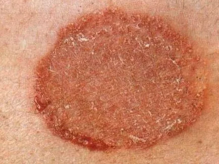Erupție cutanată și mâncărime pe corpul unui tratament adult al unei fotografii de cauza si boala (erupții cutanate) Erupție cutanată și mâncărime pe corpul unui tratament adult al cauzelor bolii și fotografii