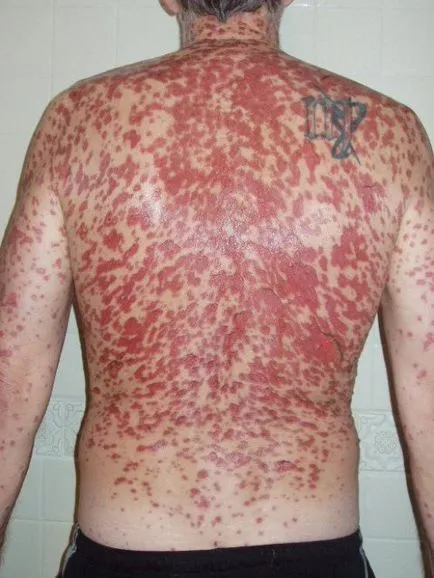 Erupție cutanată și mâncărime pe corpul unui tratament adult al unei fotografii de cauza si boala (erupții cutanate) Erupție cutanată și mâncărime pe corpul unui tratament adult al cauzelor bolii și fotografii