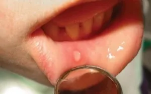 Aftele în cauzele gurii, simptome, diagnostic și tratament (cauza) Stomatită în gură cauze, simptome, diagnostic și tratament