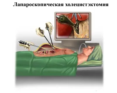 îndepărtarea colecistopatie (colecistectomia) (colecistectomia) îndepărtarea colecistopatie (colecistectomia)
