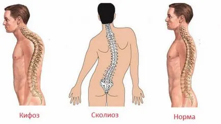 Exerciții de la aplecare pentru a scăpa de „Curve“ înapoi acasă (exerciții pentru corecție apleca) Exerciții de la aplecare pentru a scapa de „Curve“ înapoi acasă