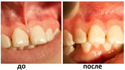 corecție Căpăstru superioară copil buze sau ștergere (căpăstru) Frenulul buzei superioare într-o corecție copil sau ștergere