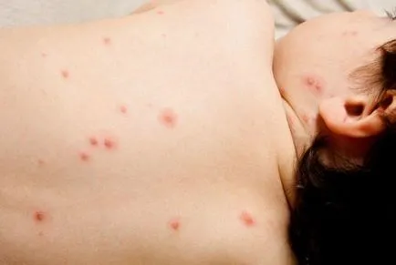 Varicela la copii fotografie, simptome, tratament, forme, complicații, prevenirea, căile de infecție (organism) Varicelă la copii fotografie, simptome, tratament, forme, complicații, prevenirea, căile de infecție