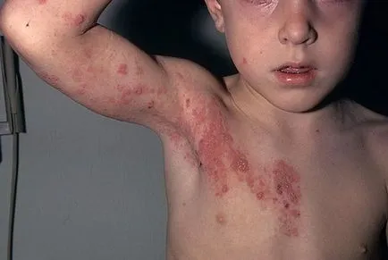 Varicela la copii fotografie, simptome, tratament, forme, complicații, prevenirea, căile de infecție (simptom) Varicelă la copii fotografie, simptome, tratament, forme, complicații, prevenirea, căile de infecție