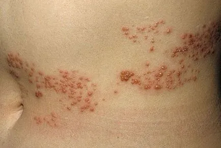 Varicela la copii fotografie, simptome, tratament, forme, complicații, prevenirea, căile de infecție (foto) Varicelă la copii fotografie, simptome, tratament, forme, complicații, prevenirea, căile de infecție