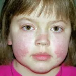 Lupus fotografie, simptomele si tratamentul bolii (tratament) Lupus fotografie, simptomele si tratamentul bolii